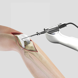 Mako Robotic-Arm Assisted Technology for total knee replacement