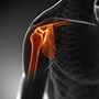 Arthritis of the Shoulder