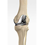 Tricompartmental Knee Replacement