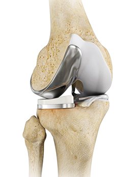 Unicompartmental Knee Replacement 