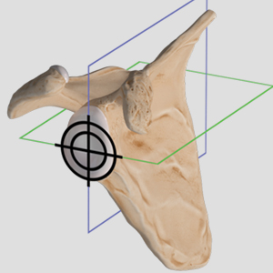 Virtual Implant Positioning by Arthrex